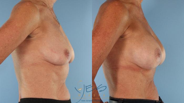 Before & After Breast Augmentation Case 587 Right Side View in Vancouver, BC