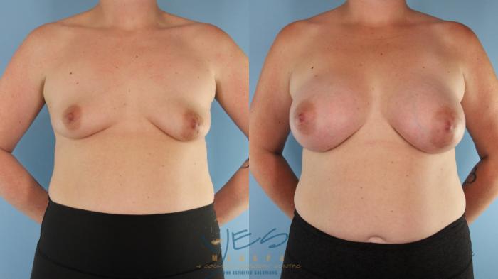 Before & After Breast Augmentation Case 598 Front View in Vancouver, BC