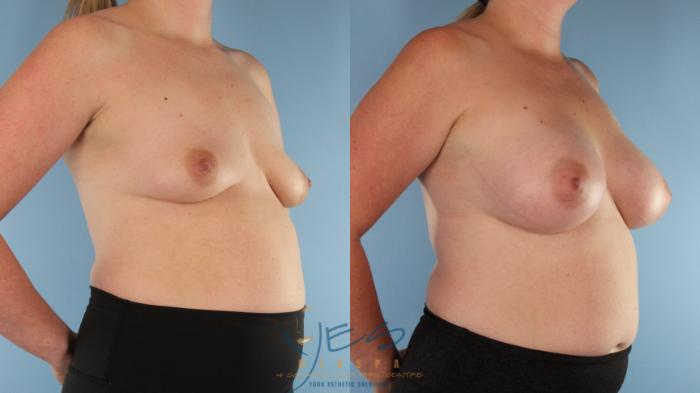 Before & After Breast Augmentation Case 598 Left Oblique View in Vancouver, BC