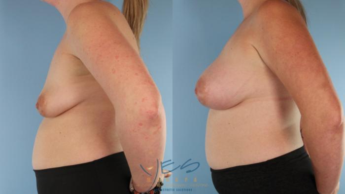 Before & After Breast Augmentation Case 598 Left Side View in Vancouver, BC