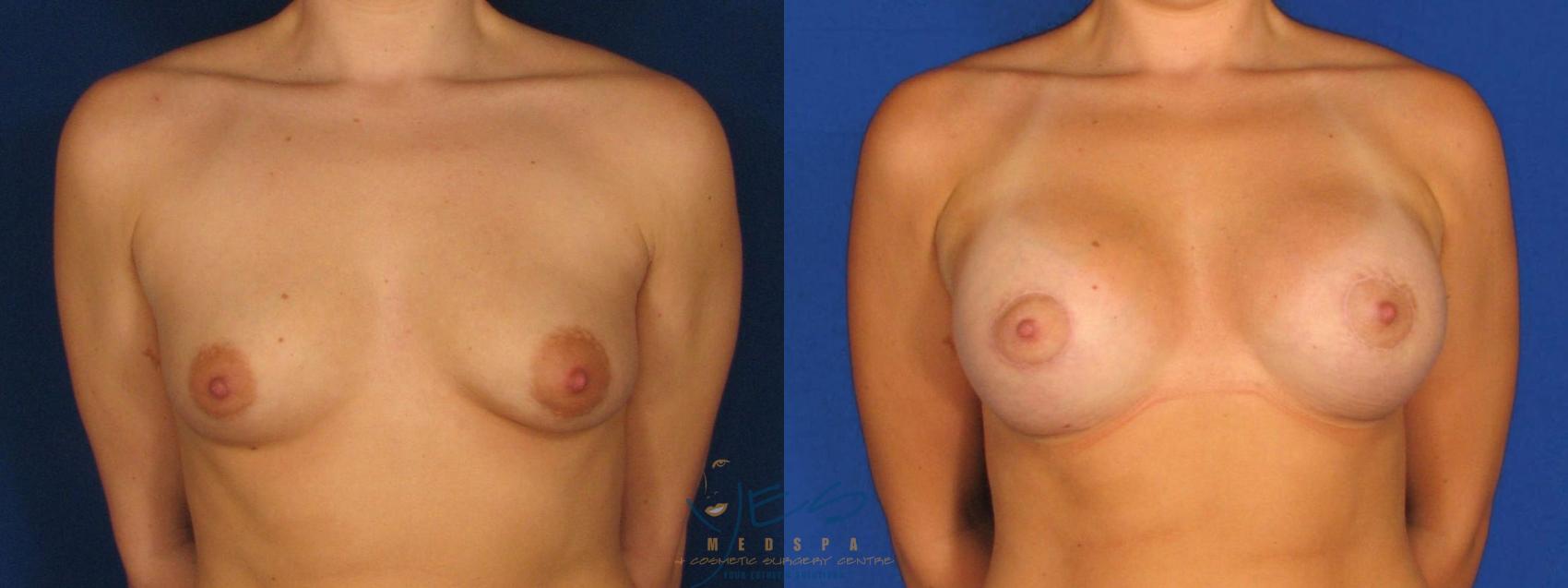 Before & After Breast Augmentation Case 6 Front View in Vancouver, BC