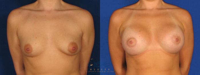 Before & After Breast Augmentation Case 6 Front View in Vancouver, BC