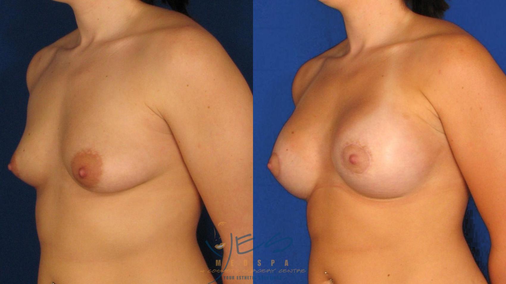 Before & After Breast Augmentation Case 6 Left Oblique View in Vancouver, BC