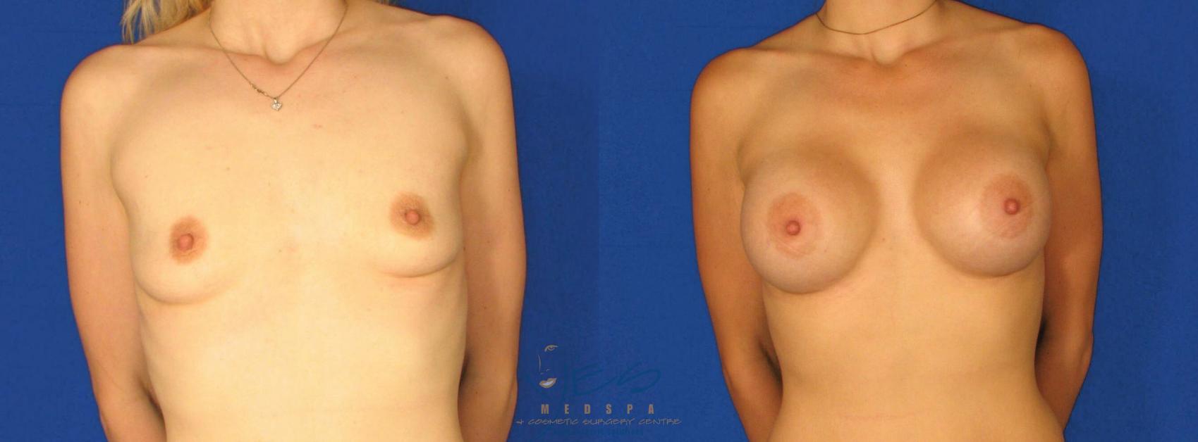 Before & After Breast Augmentation Case 63 View #1 View in Vancouver, BC