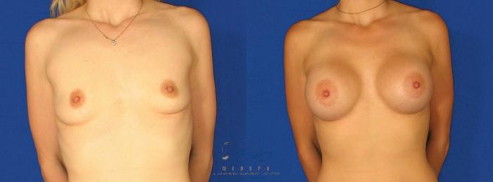 Before & After Breast Augmentation Case 63 View #1 View in Vancouver, BC
