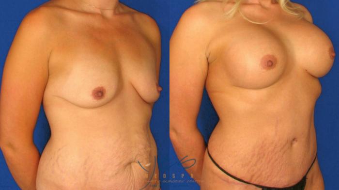 Before & After Breast Augmentation Case 66 View #4 View in Vancouver, BC