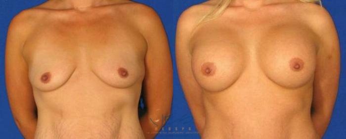Before & After Breast Augmentation Case 66 View #5 View in Vancouver, BC