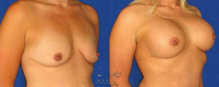 Before & After Breast Augmentation Case 66 View #6 View in Vancouver, BC