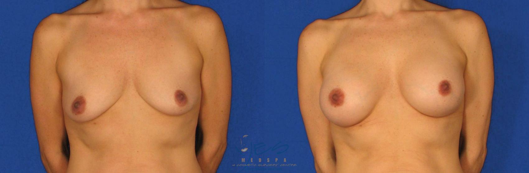 Before & After Breast Augmentation Case 69 View #1 View in Vancouver, BC
