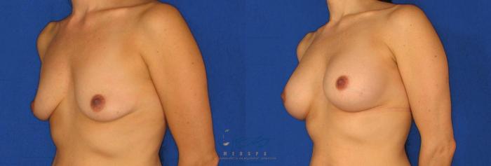Before & After Breast Augmentation Case 69 View #2 View in Vancouver, BC