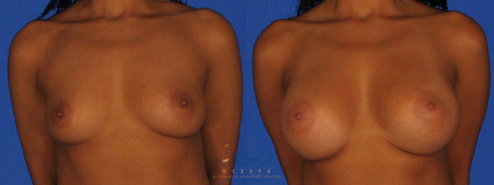 Before & After Breast Augmentation Case 7 Front View in Vancouver, BC