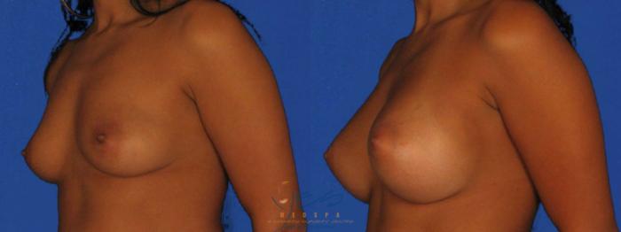 Before & After Breast Augmentation Case 7 Left Oblique View in Vancouver, BC