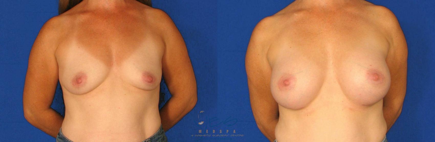 Before & After Breast Augmentation Case 70 View #1 View in Vancouver, BC