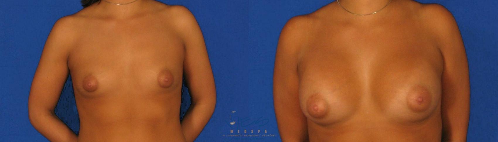 Before & After Breast Augmentation Case 73 View #1 View in Vancouver, BC