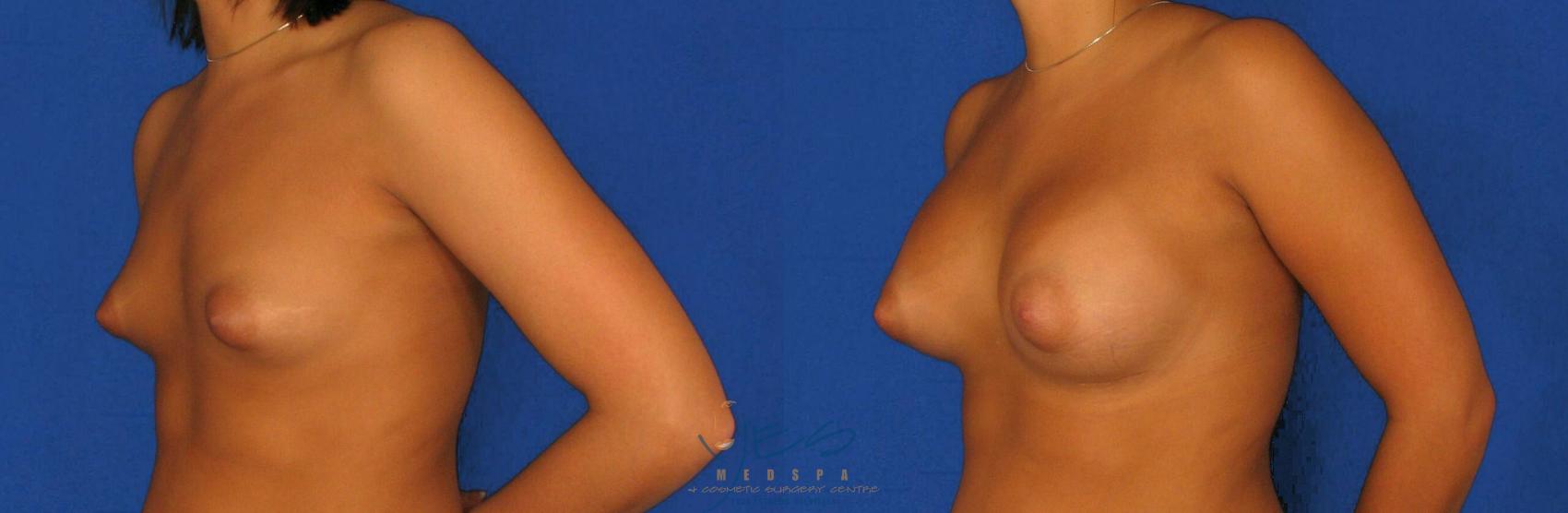 Before & After Breast Augmentation Case 73 View #2 View in Vancouver, BC