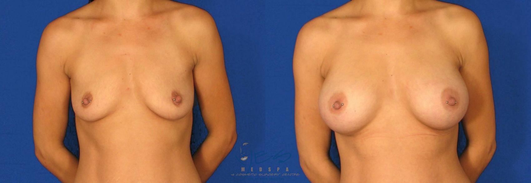 Before & After Breast Augmentation Case 74 View #1 View in Vancouver, BC