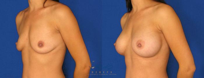 Before & After Breast Augmentation Case 74 View #2 View in Vancouver, BC