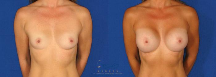 Before & After Breast Augmentation Case 75 View #1 View in Vancouver, BC