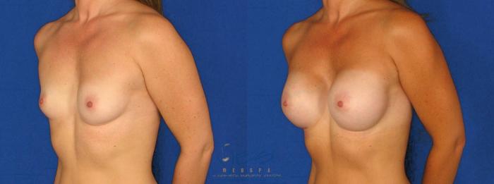 Before & After Breast Augmentation Case 75 View #2 View in Vancouver, BC