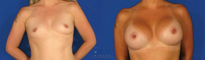 Before & After Breast Augmentation Case 77 View #1 View in Vancouver, BC