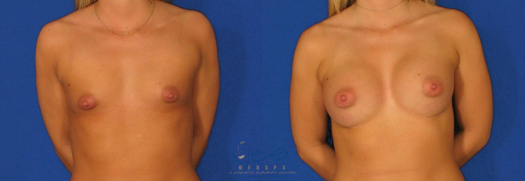 Before & After Breast Augmentation Case 78 View #1 View in Vancouver, BC