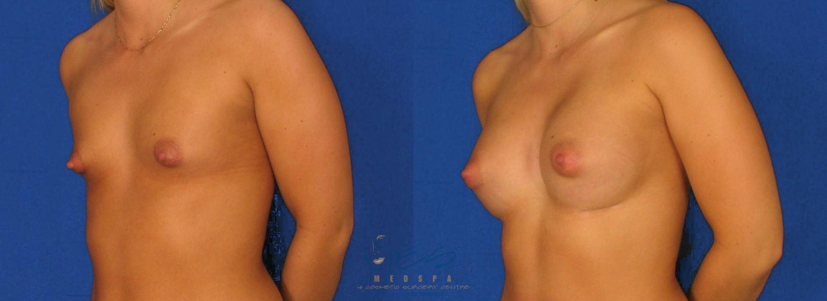 Before & After Breast Augmentation Case 78 View #2 View in Vancouver, BC