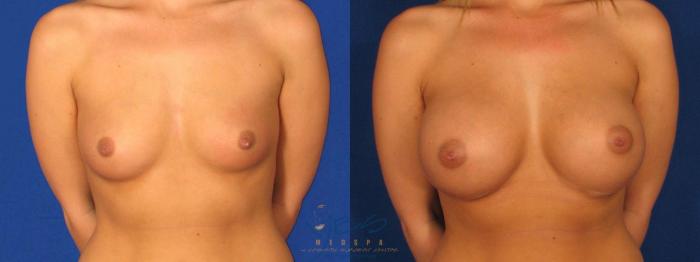Before & After Breast Augmentation Case 8 Front View in Vancouver, BC
