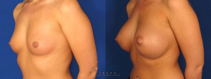 Before & After Breast Augmentation Case 8 Left Oblique View in Vancouver, BC