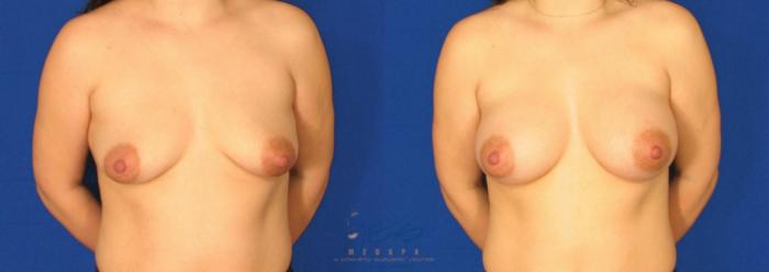 Before & After Breast Augmentation Case 82 View #1 View in Vancouver, BC