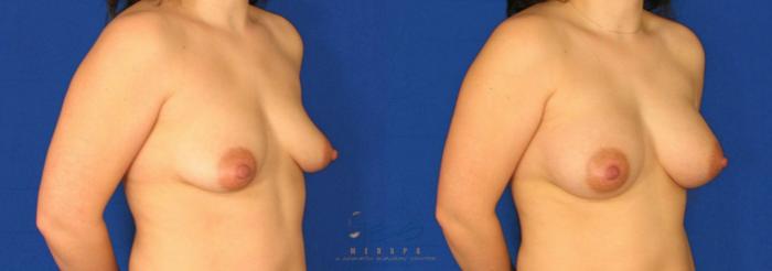 Before & After Breast Augmentation Case 82 View #2 View in Vancouver, BC