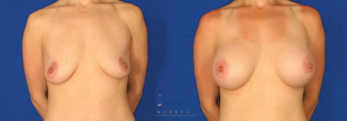 Before & After Breast Augmentation Case 83 View #1 View in Vancouver, BC
