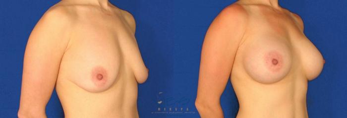 Before & After Breast Augmentation Case 83 View #2 View in Vancouver, BC