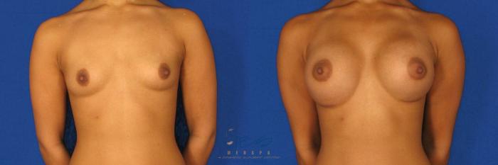 Before & After Breast Augmentation Case 84 View #1 View in Vancouver, BC
