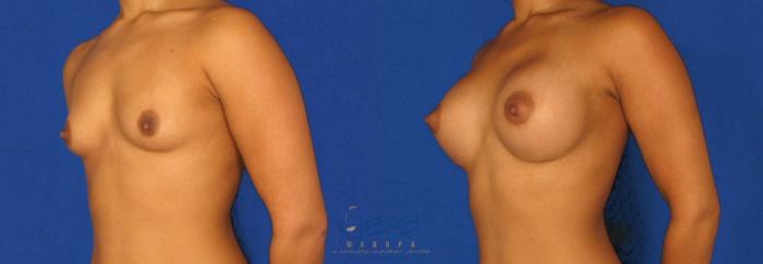 Before & After Breast Augmentation Case 84 View #3 View in Vancouver, BC