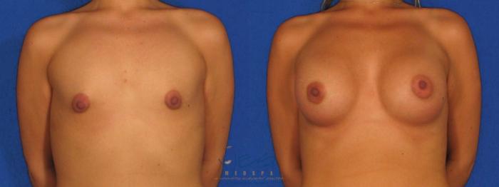 Before & After Breast Augmentation Case 9 Front View in Vancouver, BC