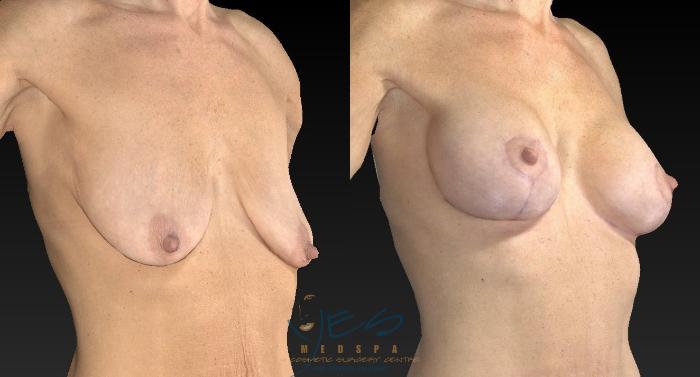Before & After Breast Augmentation and Lift Case 128 View #2 View in Vancouver, BC