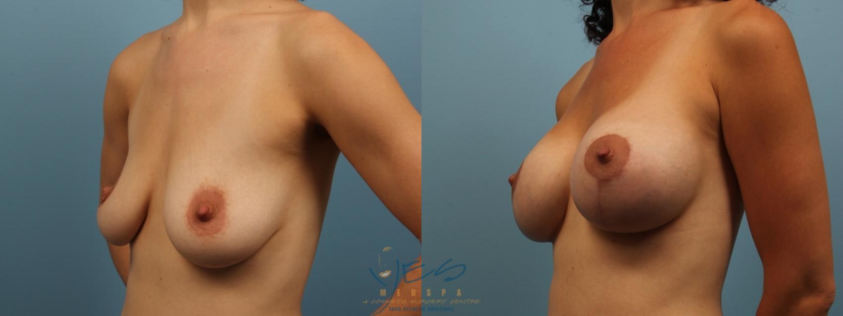 Before & After Breast Augmentation and Lift Case 156 Left Oblique View in Vancouver, BC