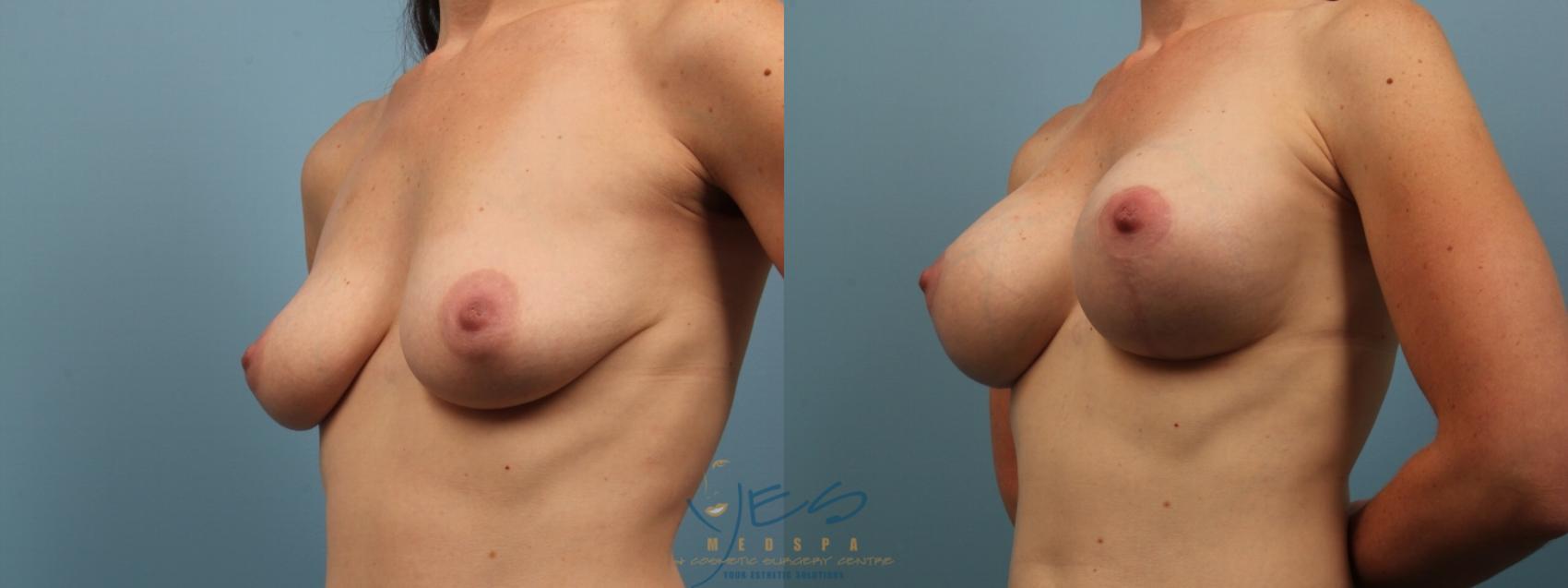 Before & After Breast Augmentation and Lift Case 157 Left Oblique View in Vancouver, BC