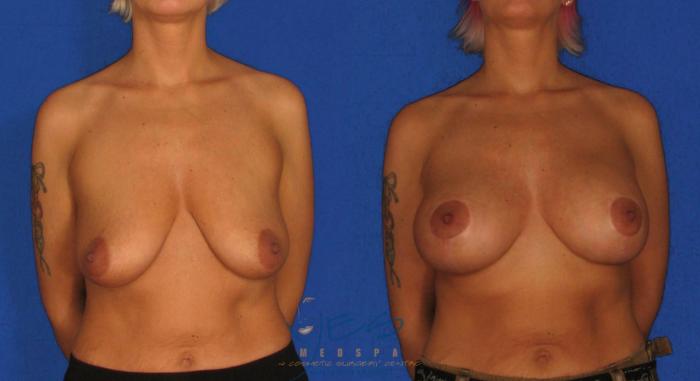 Before & After Breast Augmentation and Lift Case 16 View #1 View in Vancouver, BC