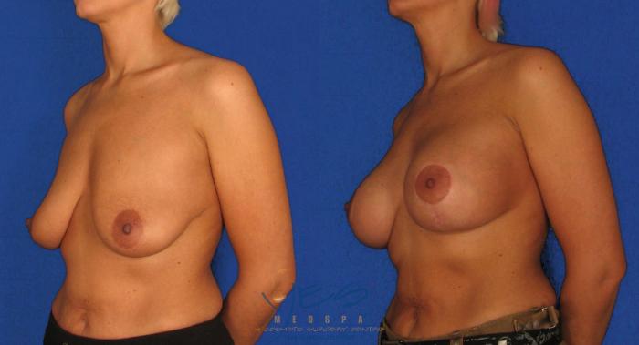 Before & After Breast Augmentation and Lift Case 16 View #2 View in Vancouver, BC