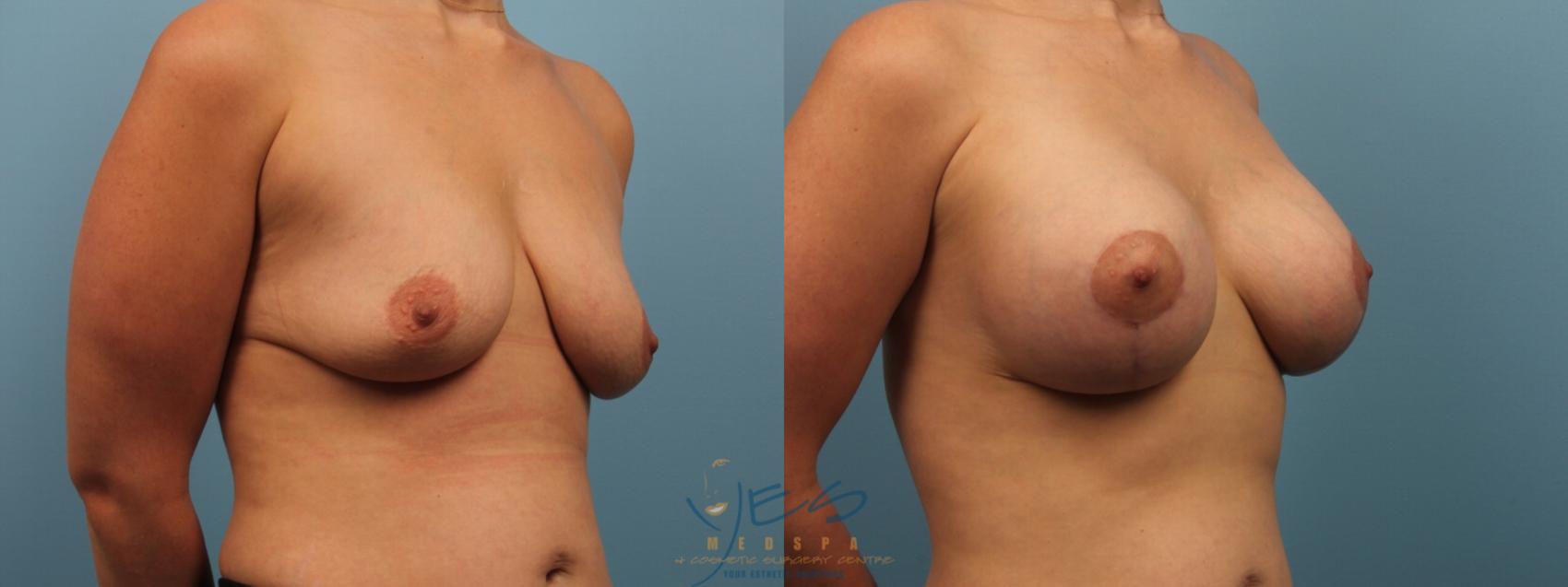 Before & After Breast Augmentation and Lift Case 170 View #2 View in Vancouver, BC