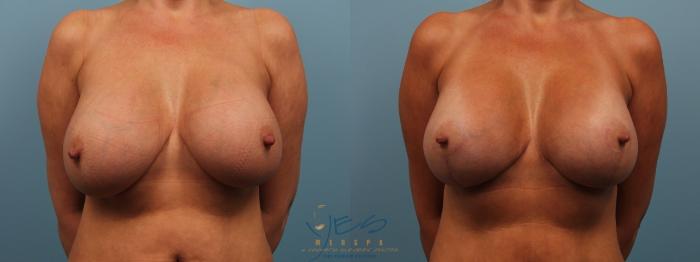 Before & After Breast Augmentation and Lift Case 178 View #1 View in Vancouver, BC