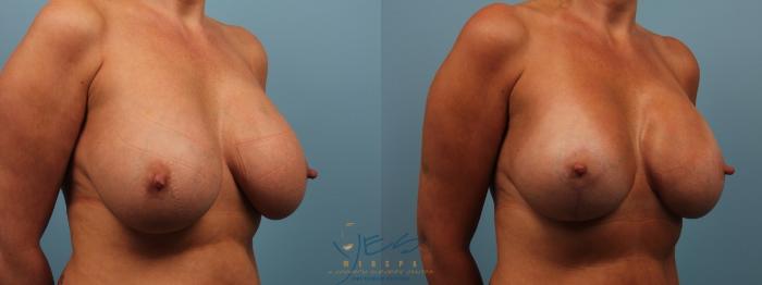 Before & After Breast Augmentation and Lift Case 178 View #2 View in Vancouver, BC