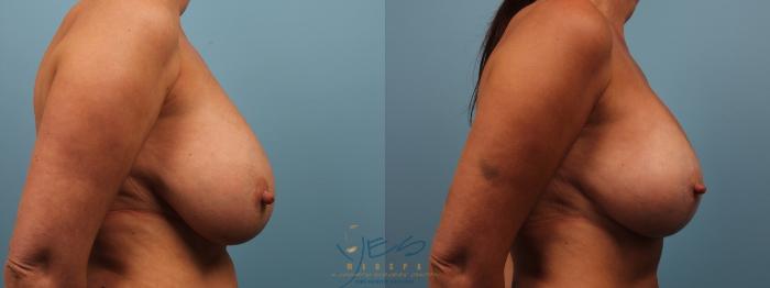 Before & After Breast Augmentation and Lift Case 178 View #3 View in Vancouver, BC