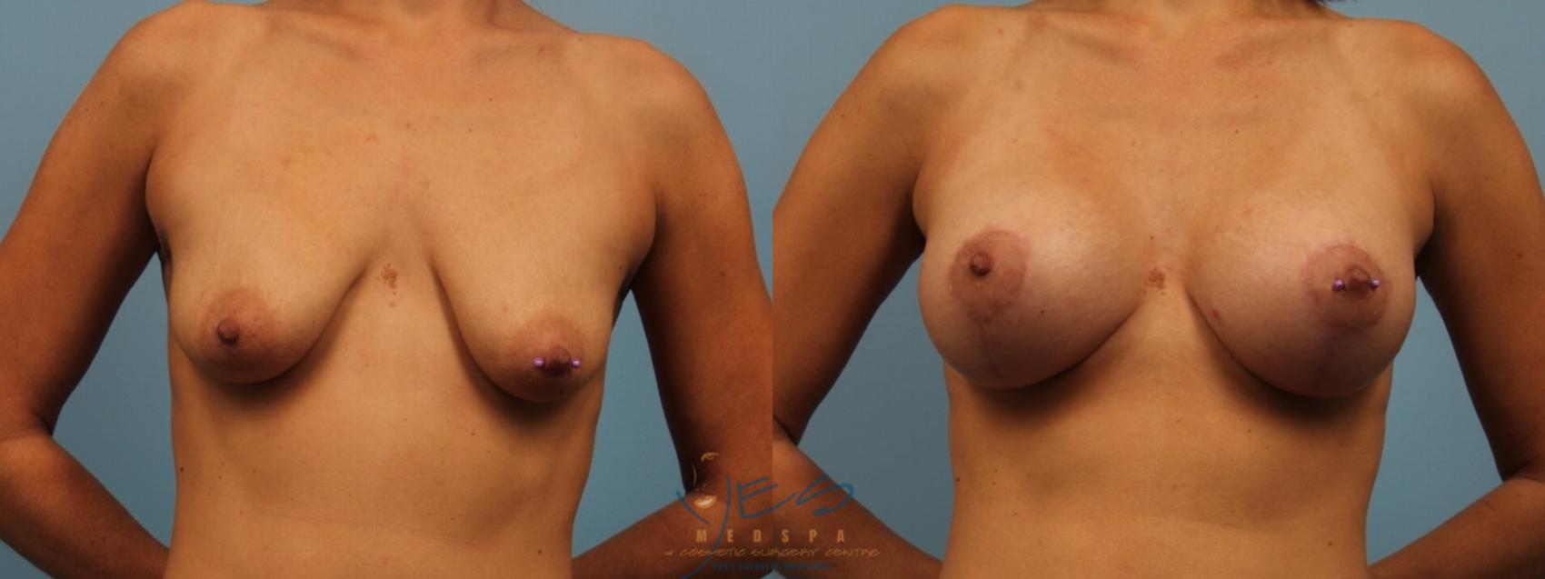 Before & After Breast Augmentation and Lift Case 179 View #1 View in Vancouver, BC