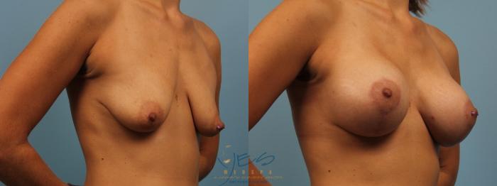 Before & After Breast Augmentation and Lift Case 179 View #2 View in Vancouver, BC