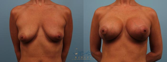 Before & After Breast Augmentation and Lift Case 182 View #1 View in Vancouver, BC