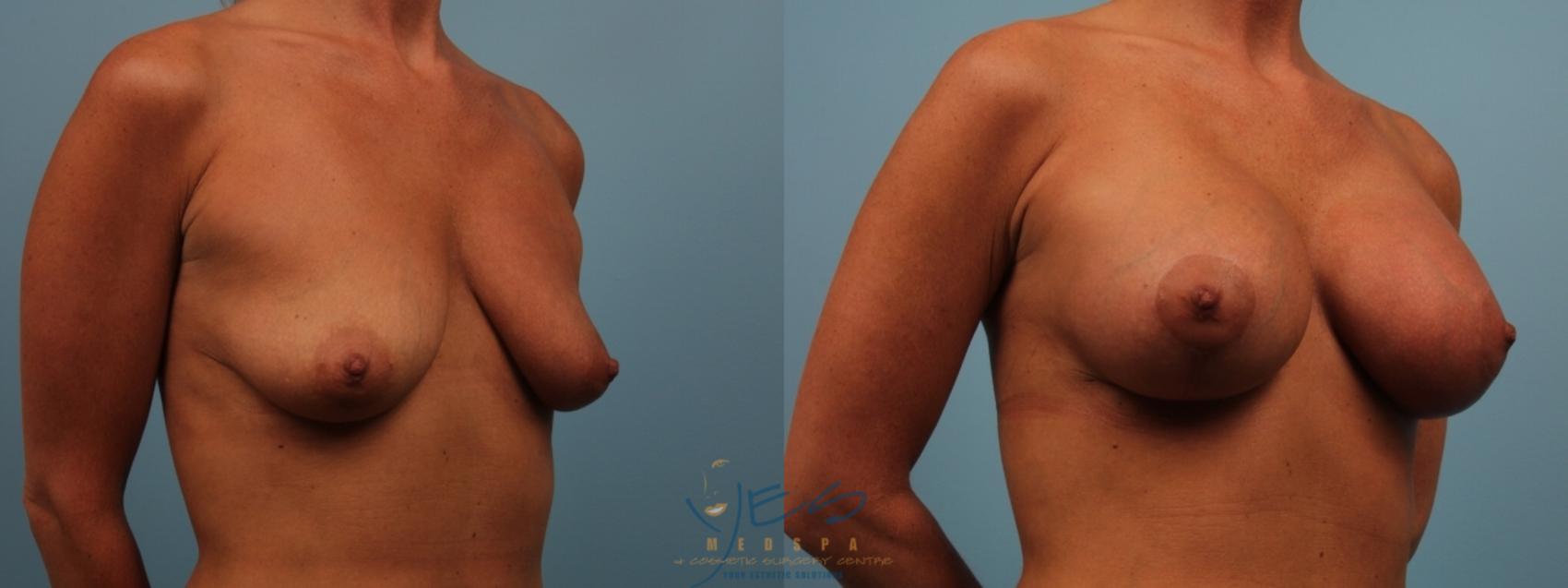 Before & After Breast Augmentation and Lift Case 182 View #2 View in Vancouver, BC