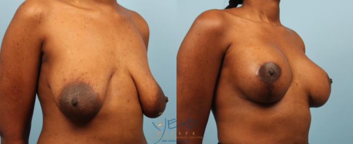 Before & After Breast Augmentation and Lift Case 187 View #2 View in Vancouver, BC