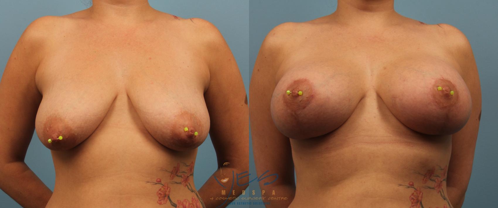 Before & After Breast Augmentation and Lift Case 202 View #1 View in Vancouver, BC